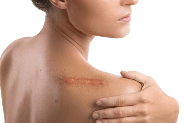 Raised red scar on a woman's shoulder, suitable for scar revision surgery